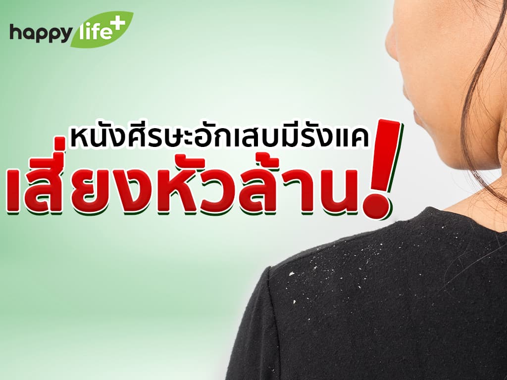 หนังศีรษะอักเสบเป็นรังแค เสี่ยงหัวล้าน